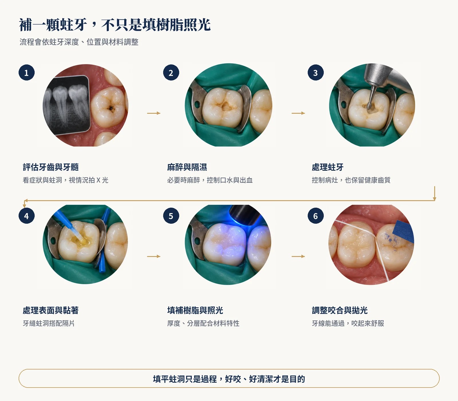 補一顆蛀牙的六個步驟插圖：評估與 X 光、麻醉與隔濕、處理蛀牙、處理表面與黏著、填補樹脂與照光、調整咬合與拋光