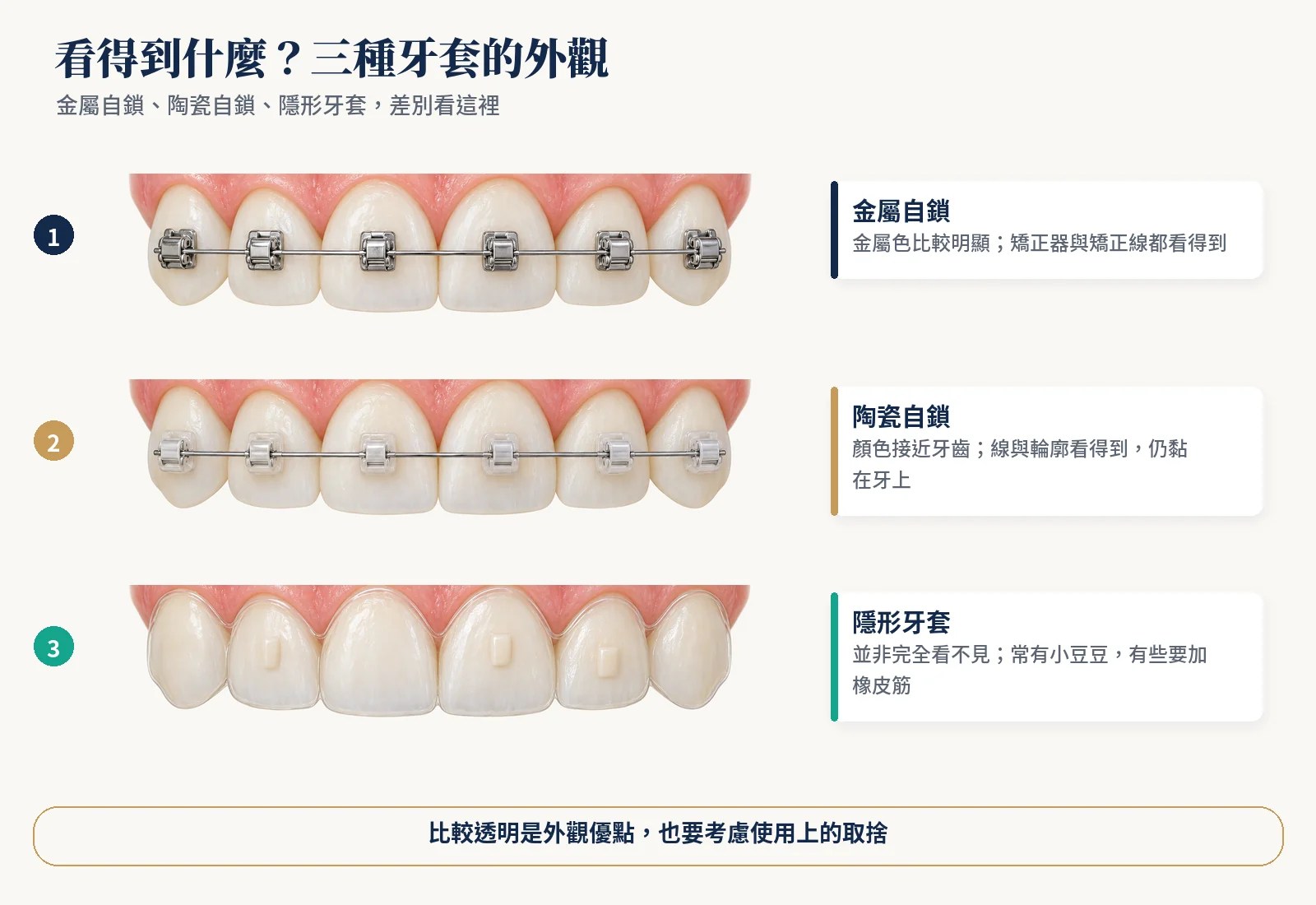 三列相同六顆上排前牙：金屬矯正器明顯，陶瓷矯正器較接近牙色但銀線清楚，透明牙套幾乎看不出來但有小豆豆。