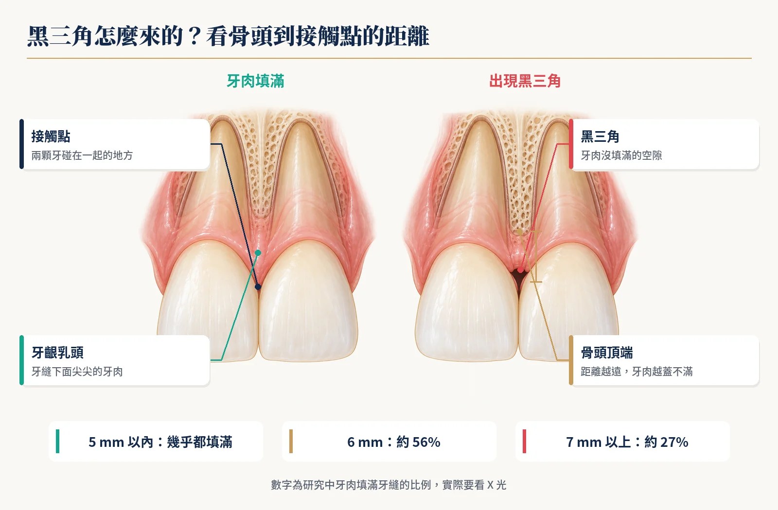 牙肉填滿與出現黑三角的門牙比較，骨頭頂端到接觸點的距離