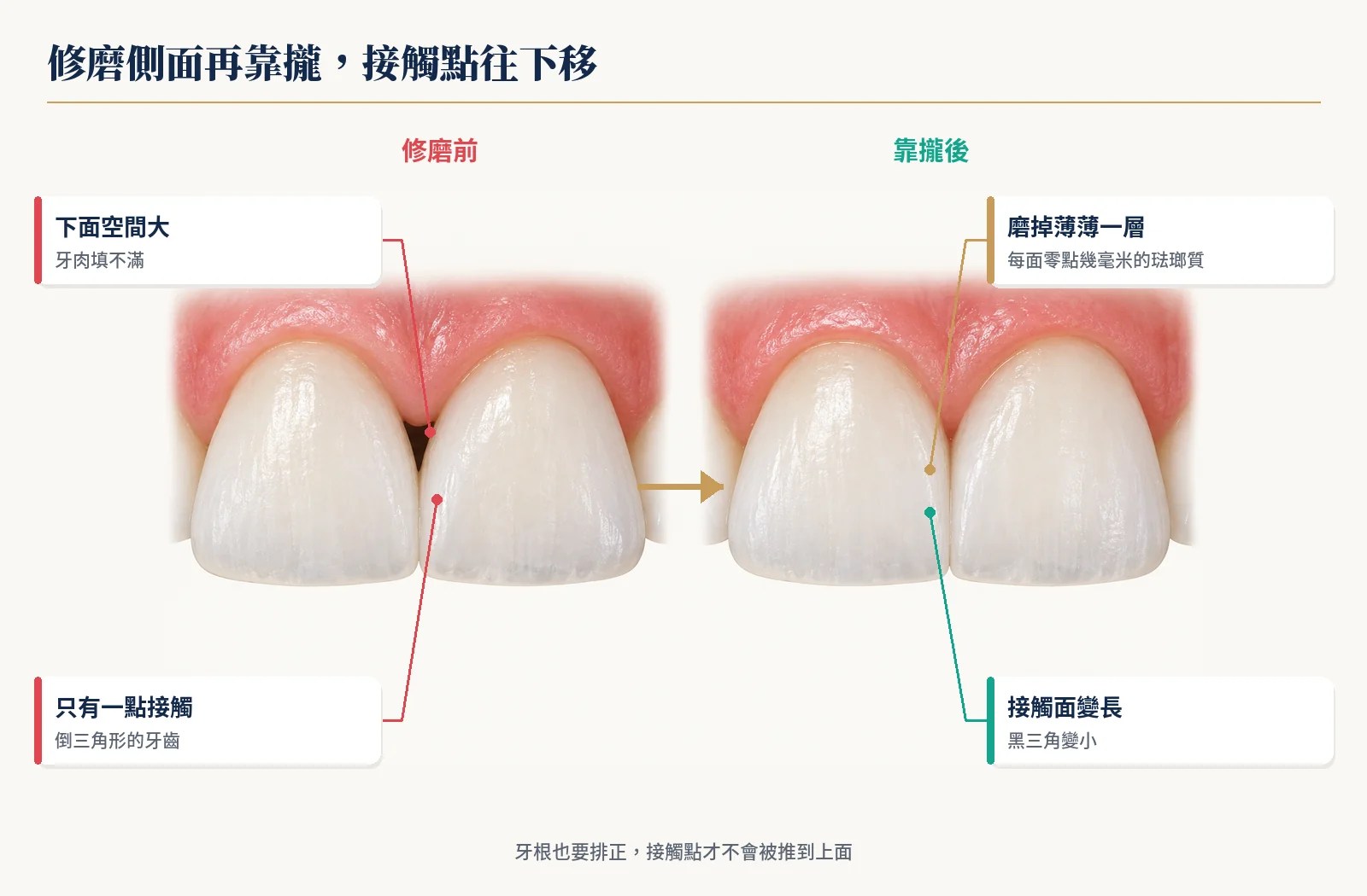 倒三角形門牙修磨側面再靠攏，接觸面變長、黑三角變小