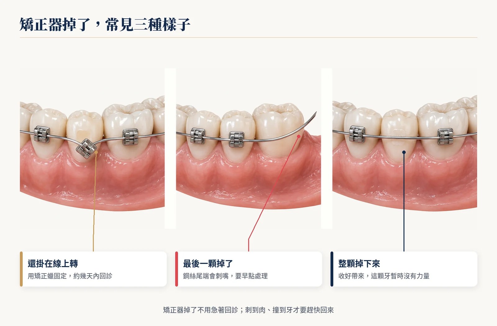 矯正器掉了常見三種樣子：還掛在線上轉、最後一顆掉了、整顆掉下來