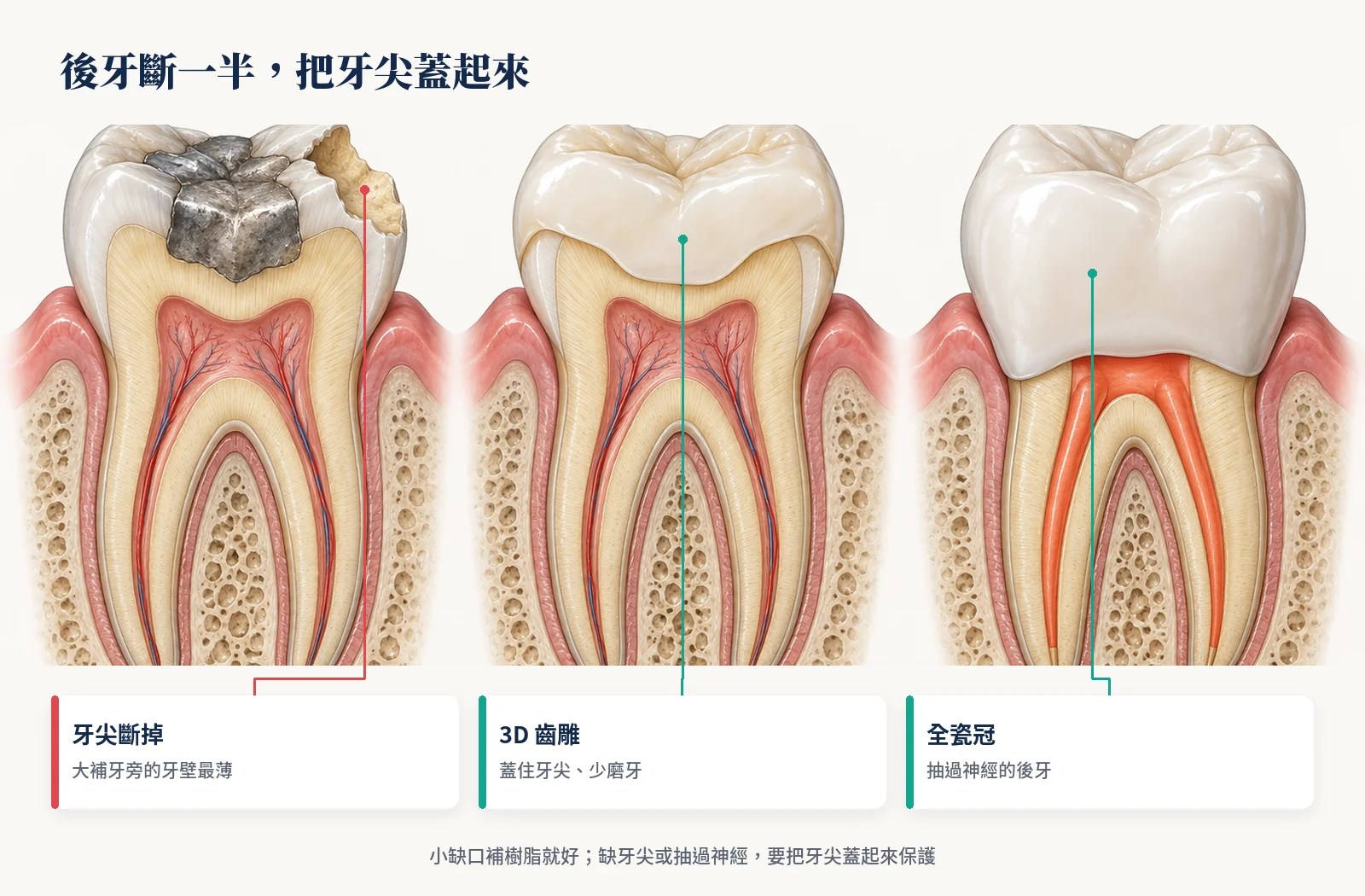 後牙斷掉一個牙尖，用 3D 齒雕或全瓷冠把牙尖蓋起來保護