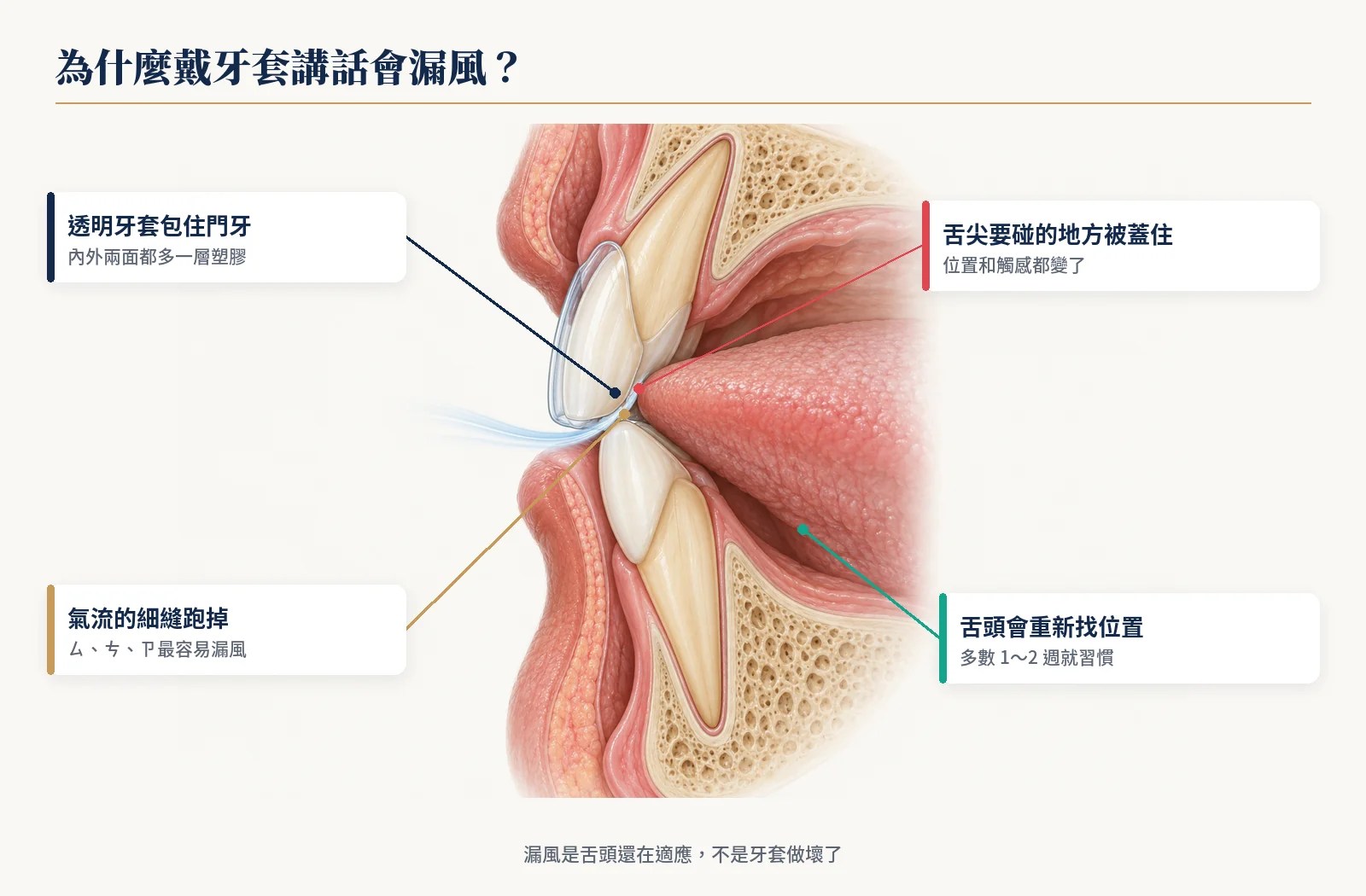 戴隱形牙套講話漏風的原因：牙套包住上門牙，舌尖接觸位置改變