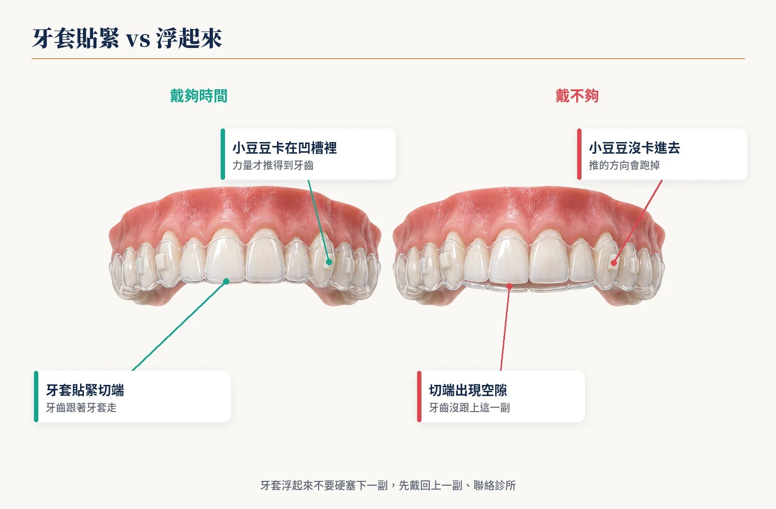 隱形牙套貼緊與沒戴到底的對比：左邊貼合，右邊門牙切端留下約 2～3 毫米空隙