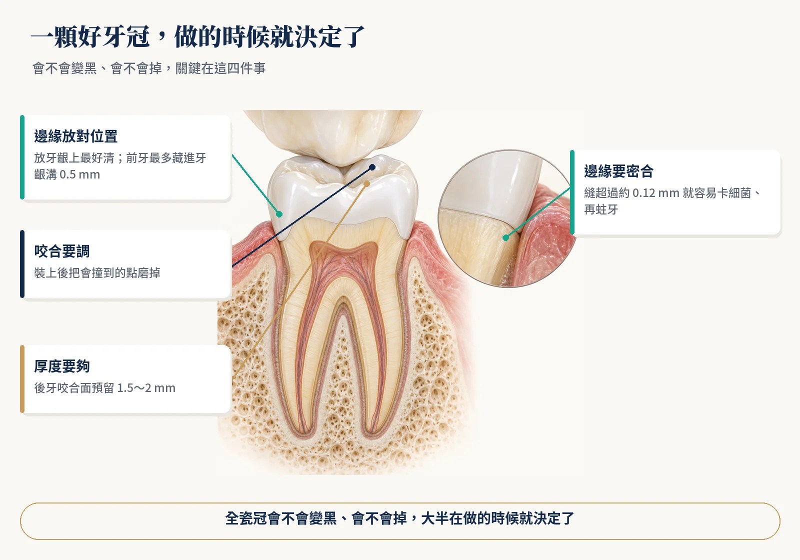 全瓷冠的四個關鍵：邊緣位置、邊緣密合、咬合面厚度、咬合調整