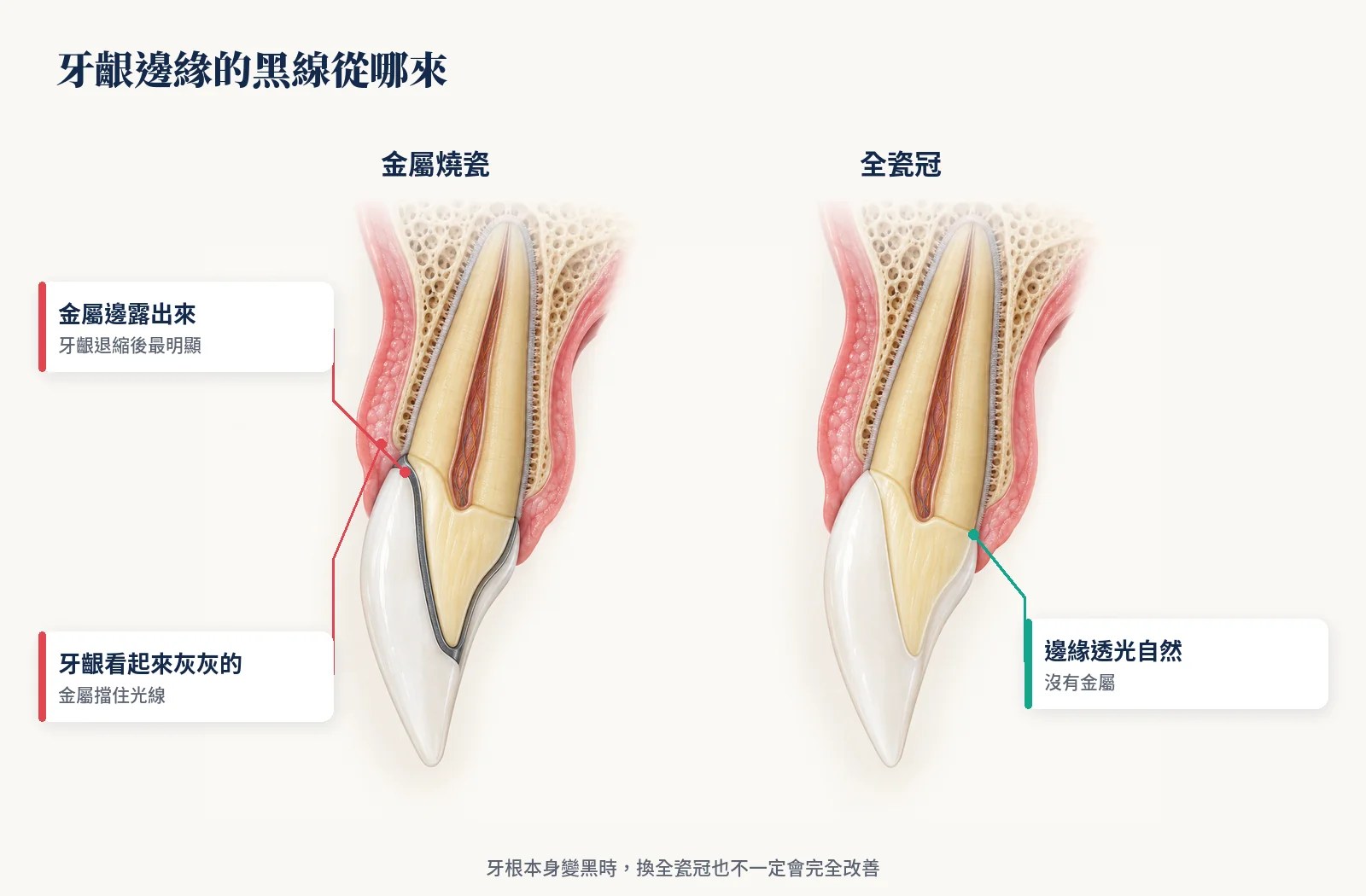 金屬燒瓷牙冠與全瓷冠的門牙側面剖面：牙冠邊緣落在真牙上，金屬燒瓷在邊緣露出深灰金屬線