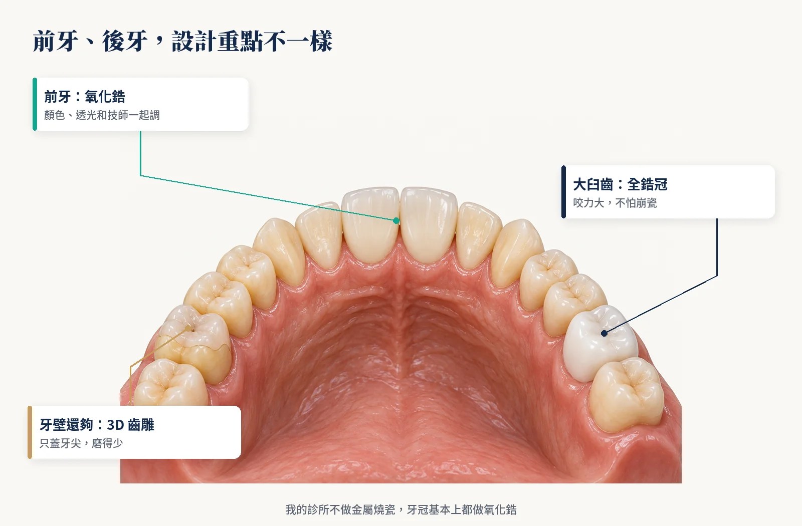 氧化鋯牙冠在前牙與大臼齒、後牙3D齒雕的牙列模型