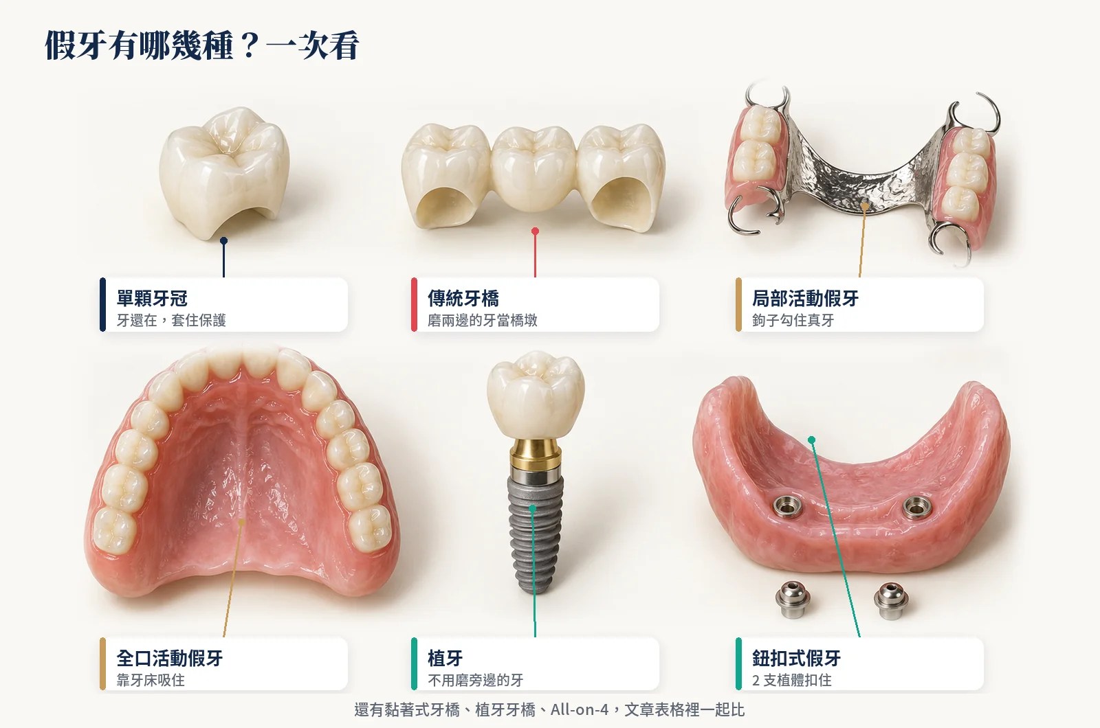 假牙種類：單顆牙冠、傳統牙橋、局部活動假牙、全口活動假牙、植牙、鈕扣式假牙
