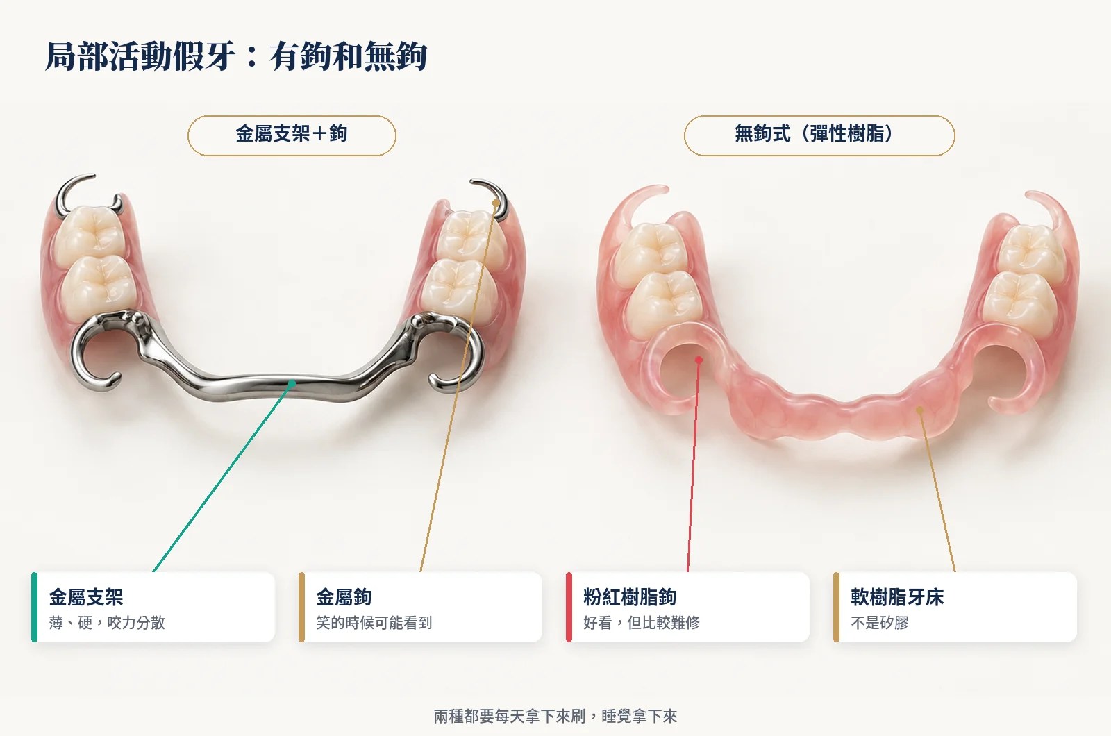 金屬支架加金屬鉤的局部活動假牙與無鉤式彈性樹脂局部假牙比較