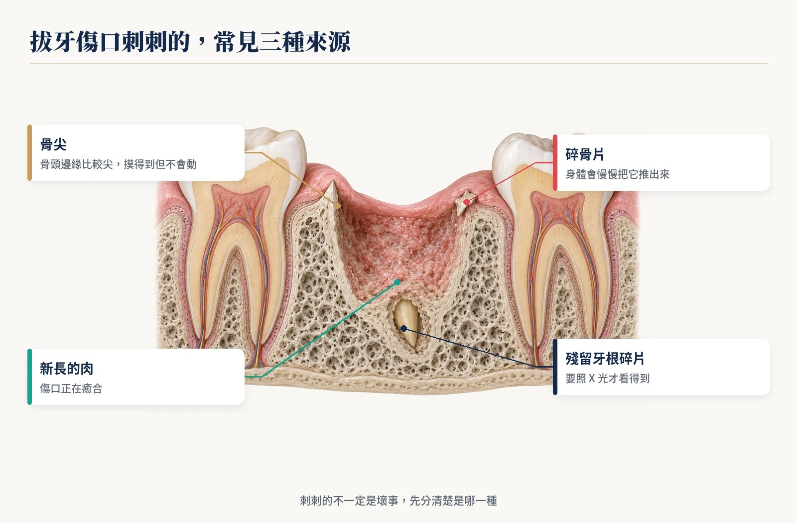 拔牙傷口刺刺的三種來源：拔牙窩邊緣的骨尖、正被推出的碎骨片與殘留牙根碎片