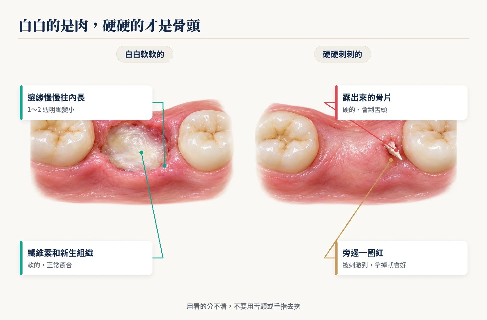 拔牙傷口白白軟軟的纖維素與新生組織，對照硬硬刺刺露出牙齦的骨片