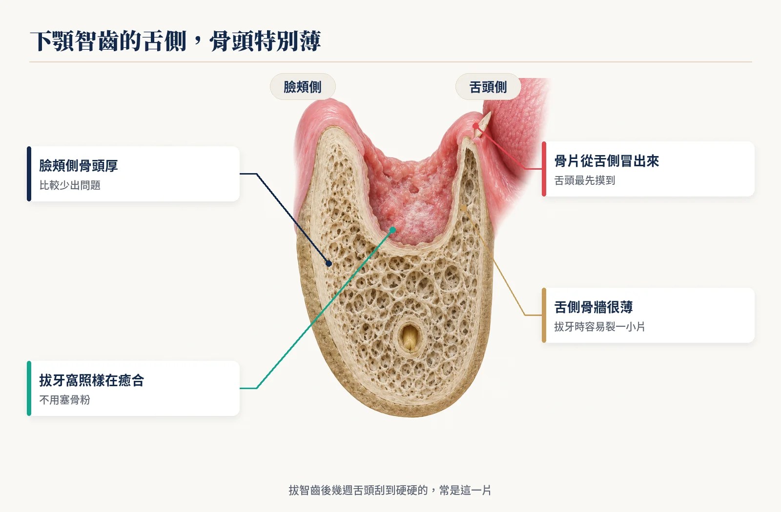 下顎智齒冠狀切面：舌側骨牆很薄，碎骨片從舌側牙齦冒出
