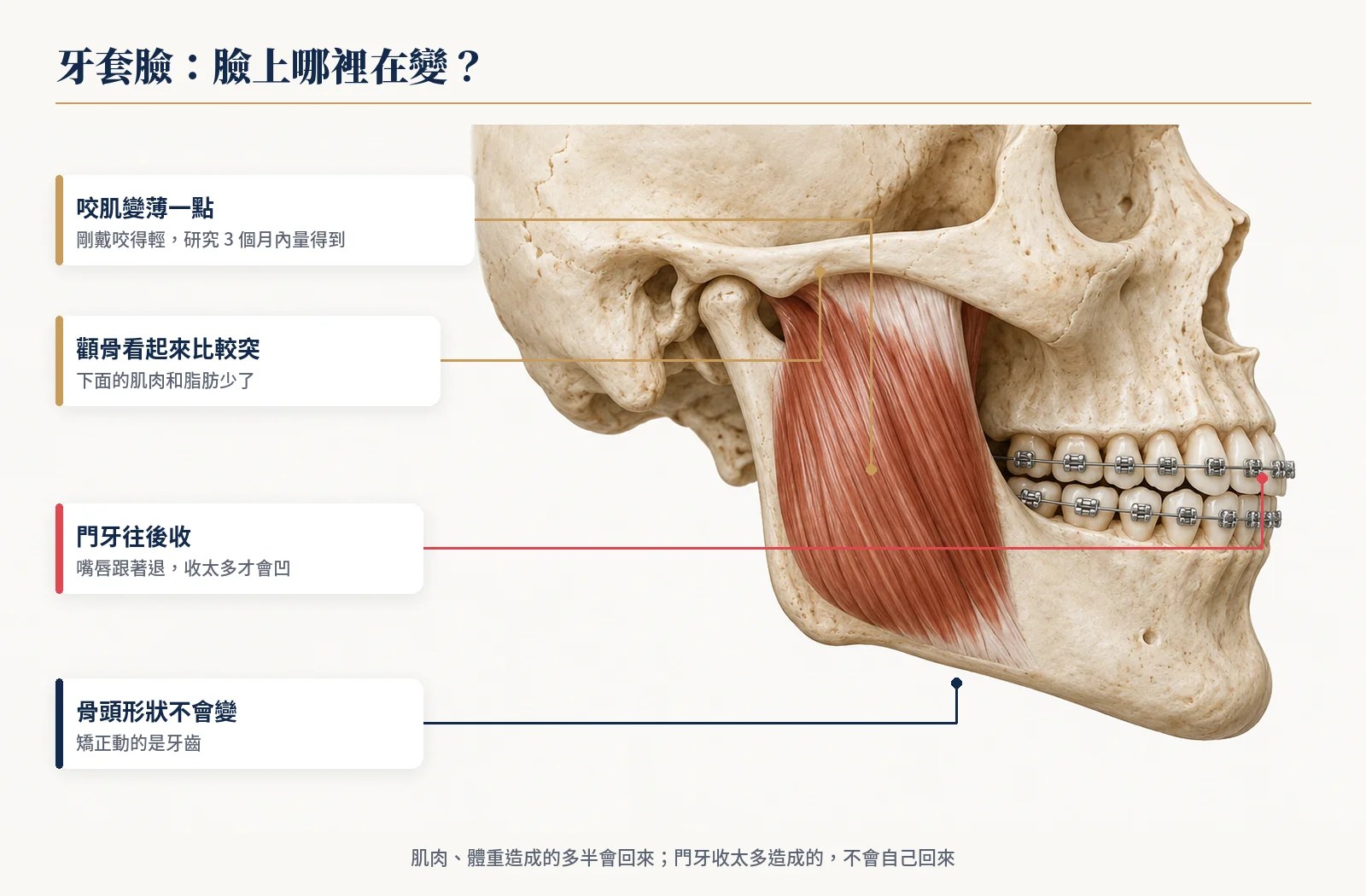 牙套臉臉上哪裡在變：咬肌變薄、顴骨看起來突、門牙往後收，骨頭形狀不變
