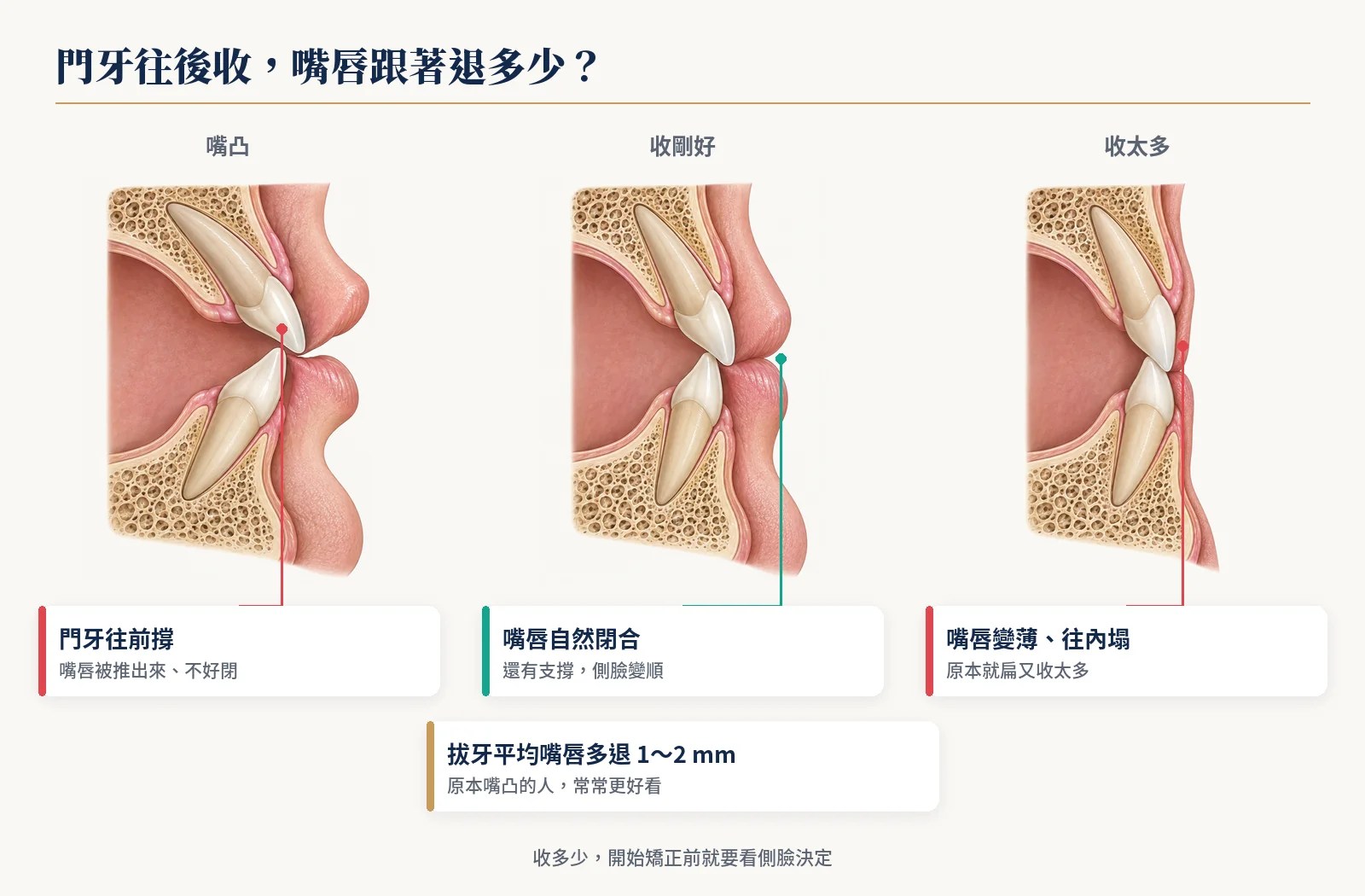 門牙往後收、嘴唇跟著退的側面剖面三格：嘴凸、收剛好、收太多（上下門牙都再往內收、嘴唇變薄）