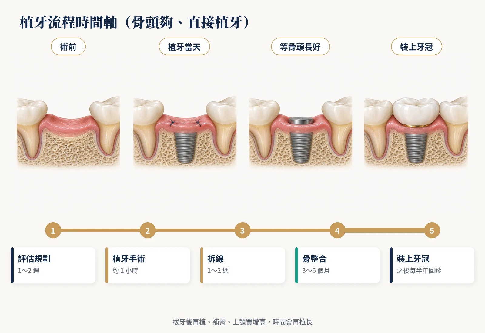植牙流程時間軸：評估規劃、植牙手術、拆線、骨整合、裝上牙冠