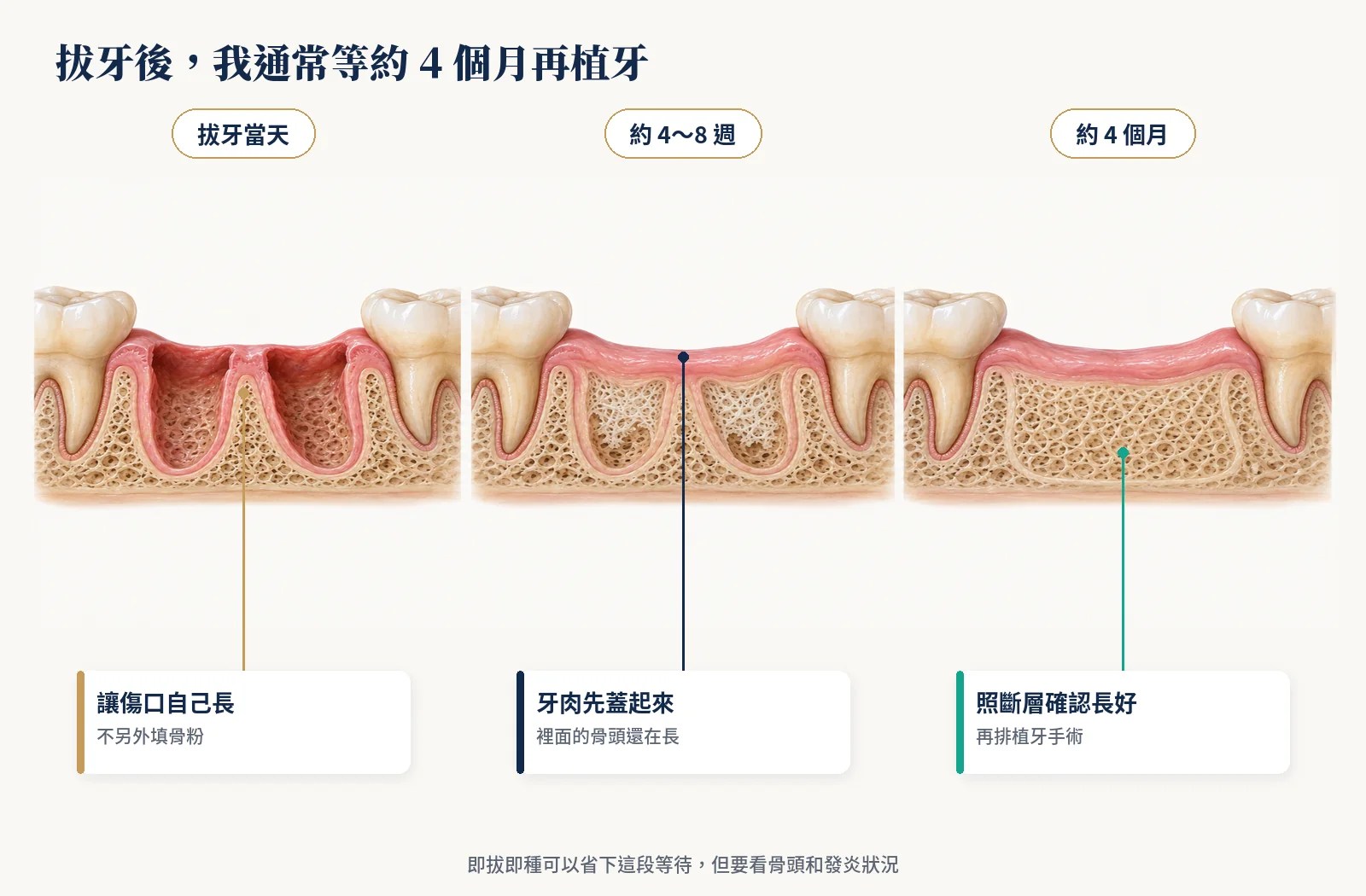 拔牙後牙窩癒合：拔牙當天、約4到8週牙肉蓋起來、約4個月新骨填滿