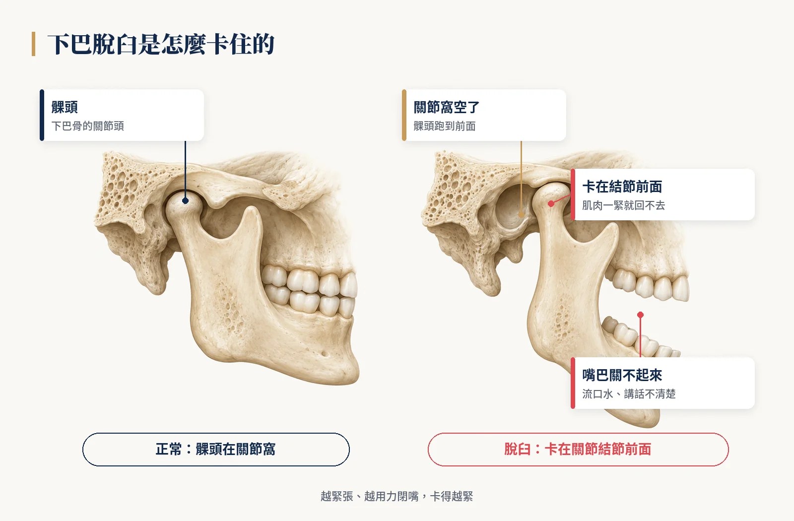 下巴脫臼：髁頭滑到關節結節前面卡住，嘴巴關不起來