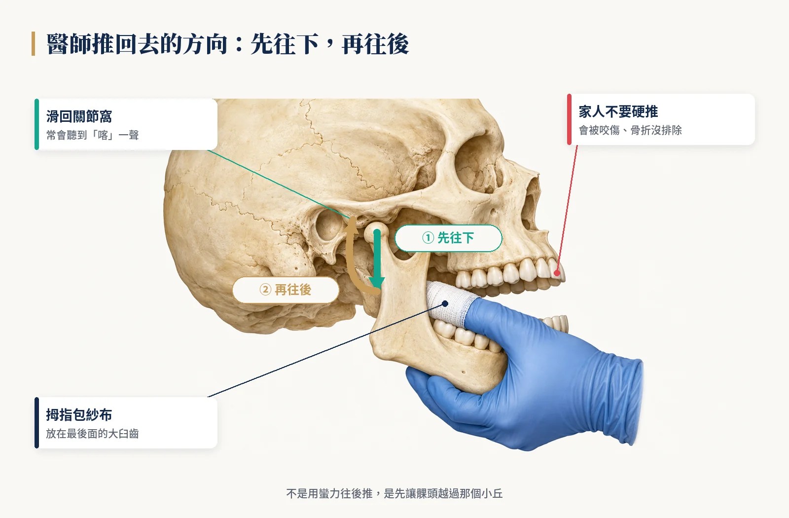 醫師把脫臼的下巴推回去：拇指包紗布放在最後面的大臼齒，先往下再往後
