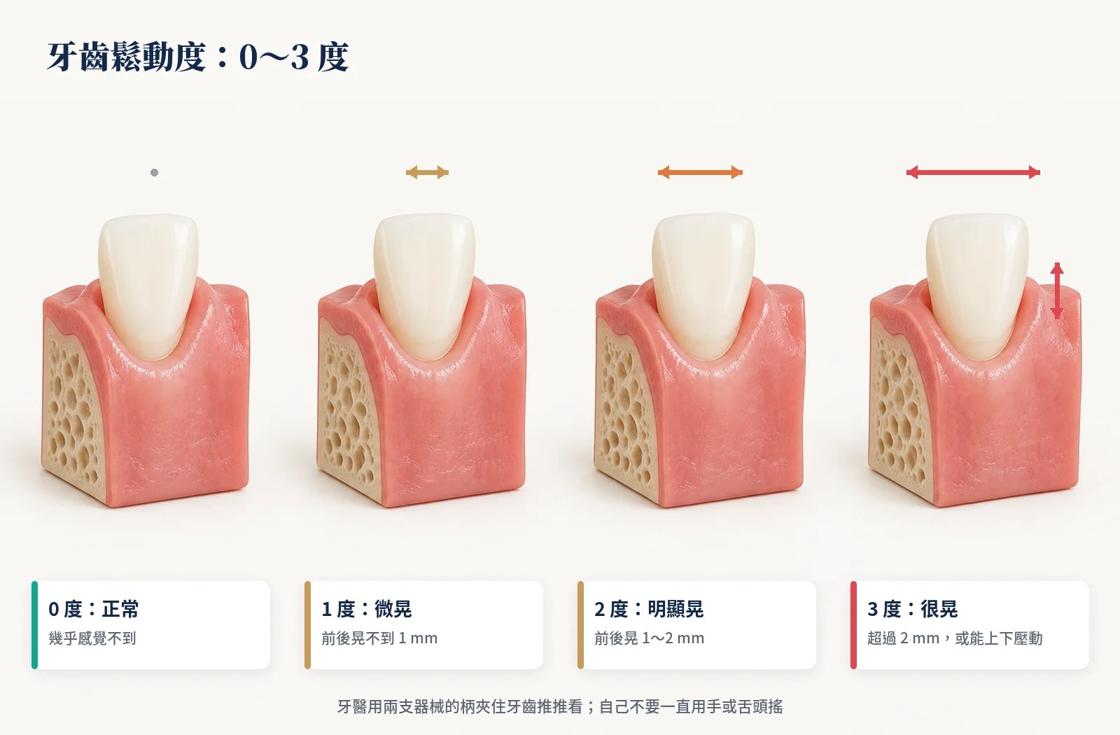 牙齒鬆動度 0 到 3 度，晃動幅度越大等級越高