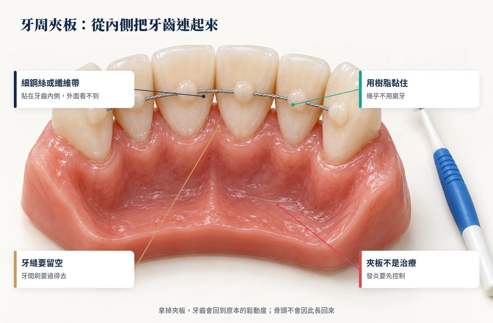 牙周夾板：細鋼絲用樹脂黏在下排前牙內側