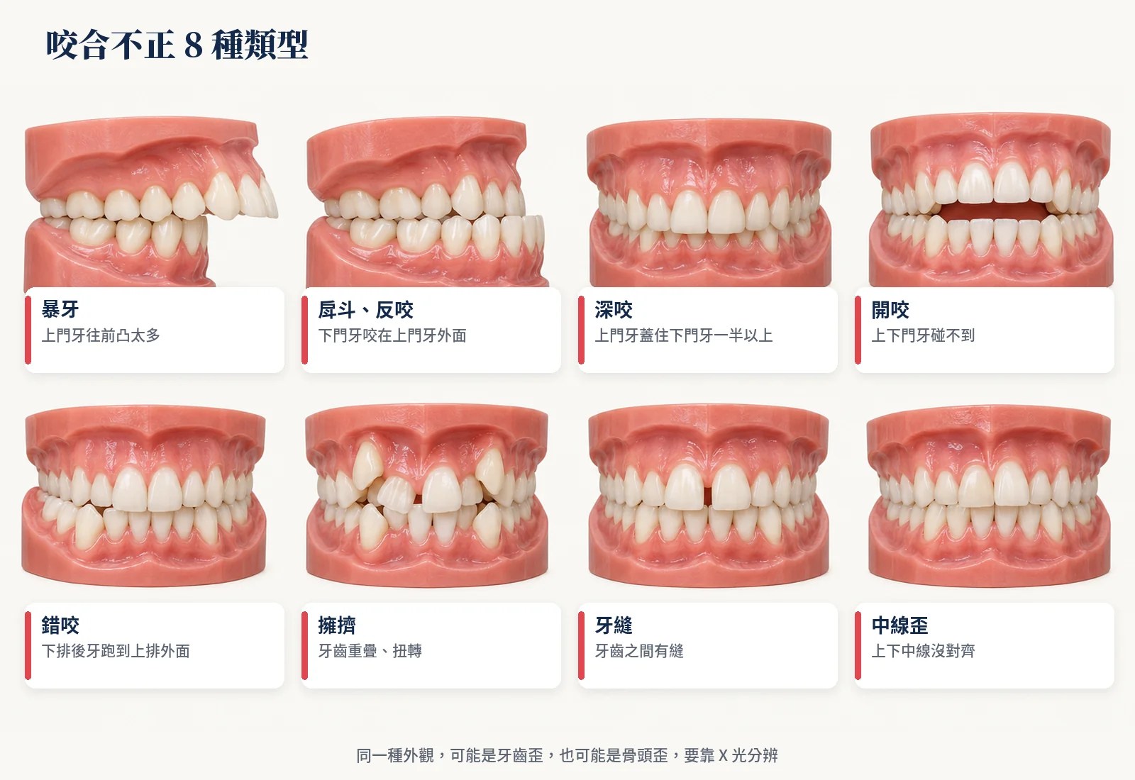 咬合不正 8 種類型：暴牙、戽斗反咬、深咬、開咬、錯咬、擁擠、牙縫、中線歪的牙齒模型