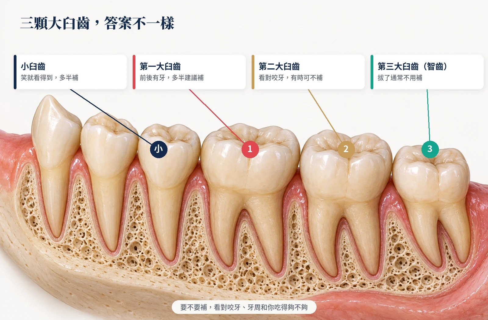 小臼齒、第一、第二、第三大臼齒拔掉後要不要補的對照