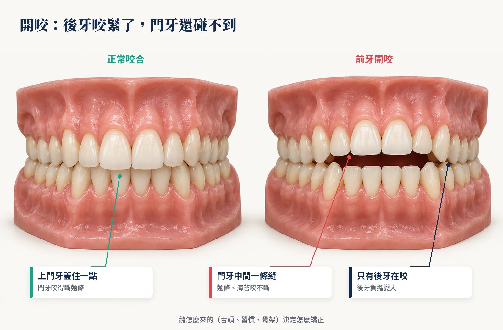 正常咬合與前牙開咬的牙齒模型比較，開咬時後牙咬緊、門牙之間留一條縫