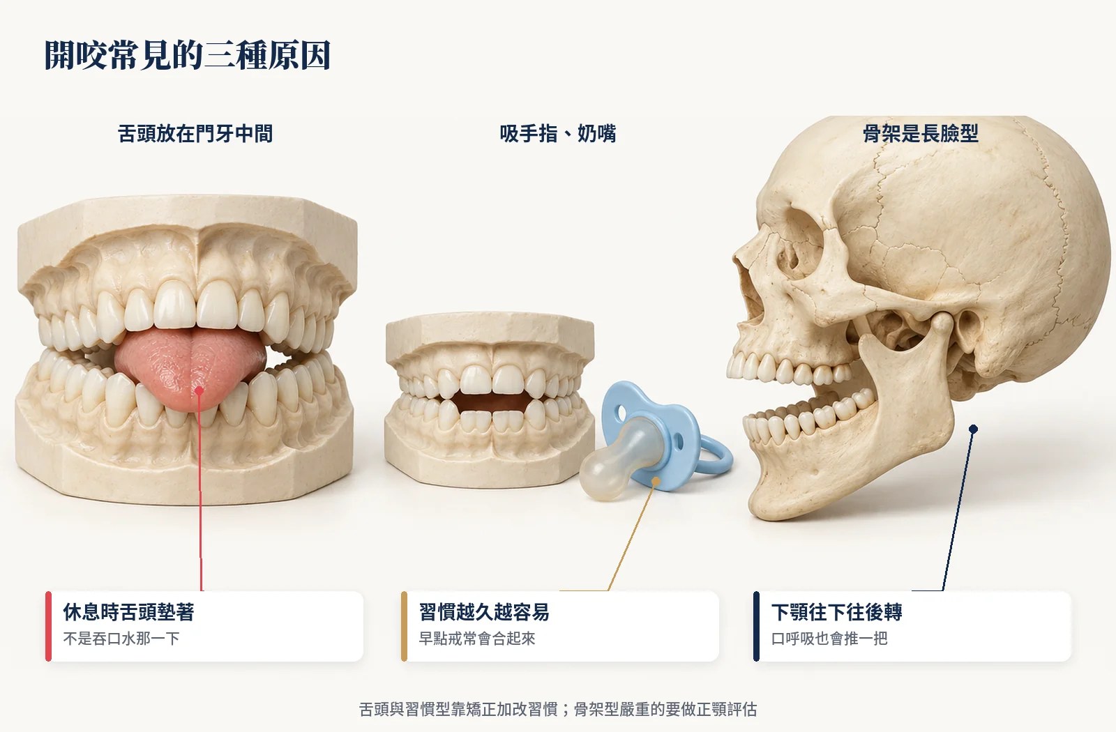 開咬常見三種原因：舌頭放在門牙中間、吸手指或奶嘴、長臉型骨架