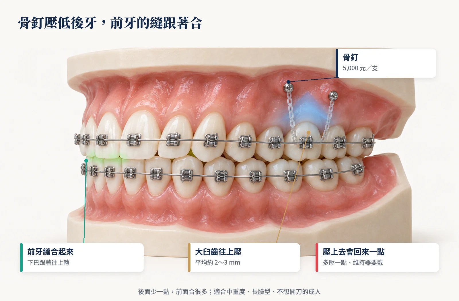 骨釘把大臼齒往上壓，前牙的開咬跟著合起來的矯正牙齒模型