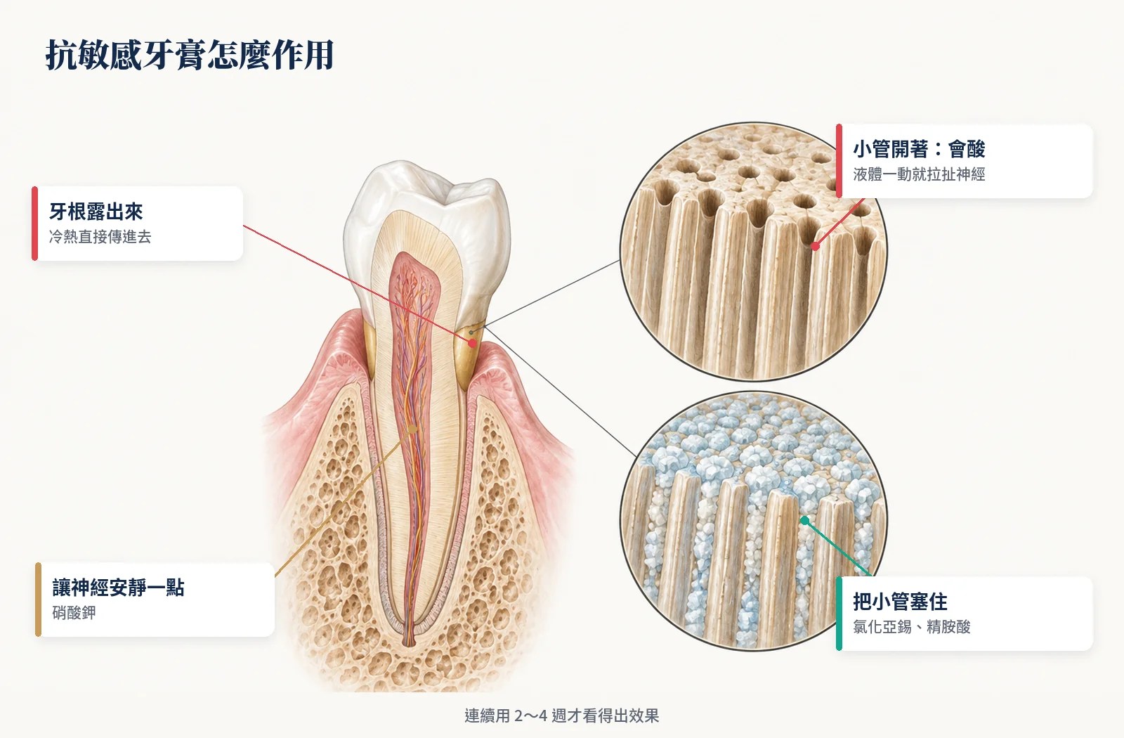 抗敏感牙膏作用：牙根外露、牙本質小管打開與被堵住