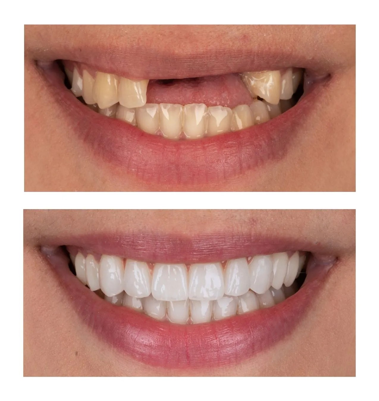 Two-panel comparison of a smile: top shows yellowed, uneven teeth; bottom shows a bright, even white smile after whitening.