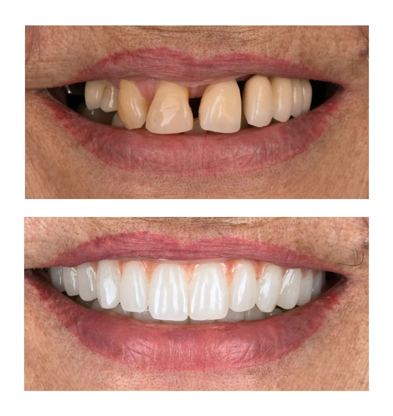 Before-and-after close-up of a smile: top image shows worn, discolored teeth with gaps; bottom image shows a full set of bright, straight veneers after treatment.