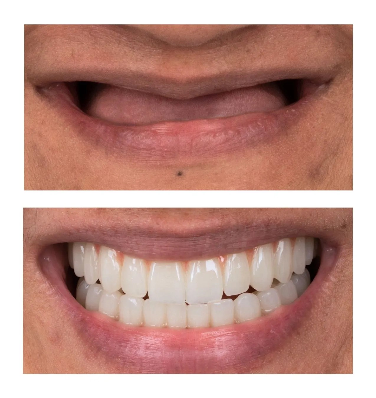 Before-and-after close-up of a smile: top image shows a closed-mouth expression with darker, natural teeth; bottom image shows a wide smile with noticeably whiter, even teeth from a dental whitening/veneers treatment.