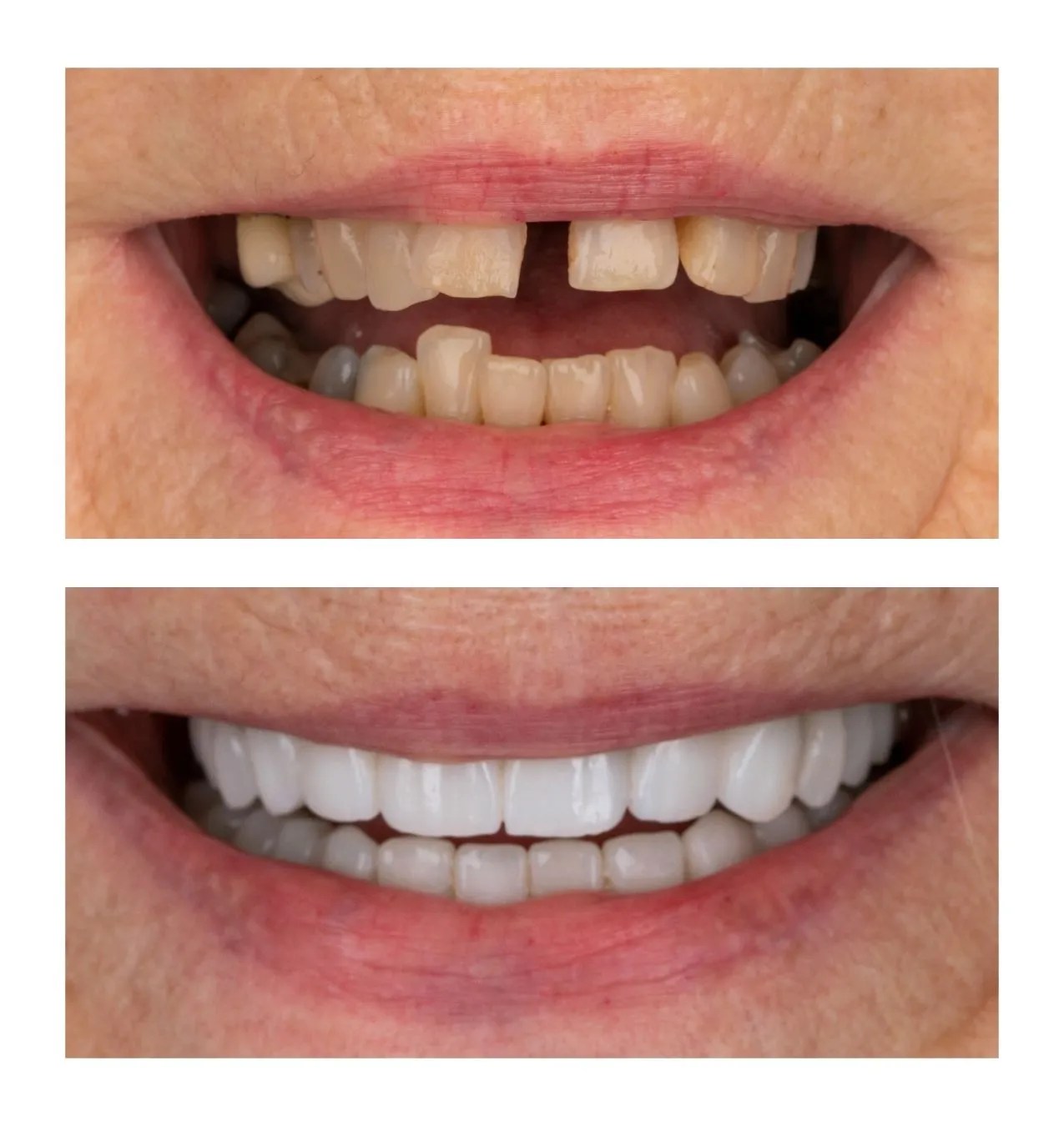 Before-and-after close-up of a smile: upper teeth misaligned and discolored in the top image, with a straight, bright white set of teeth in the bottom image after dental treatment.