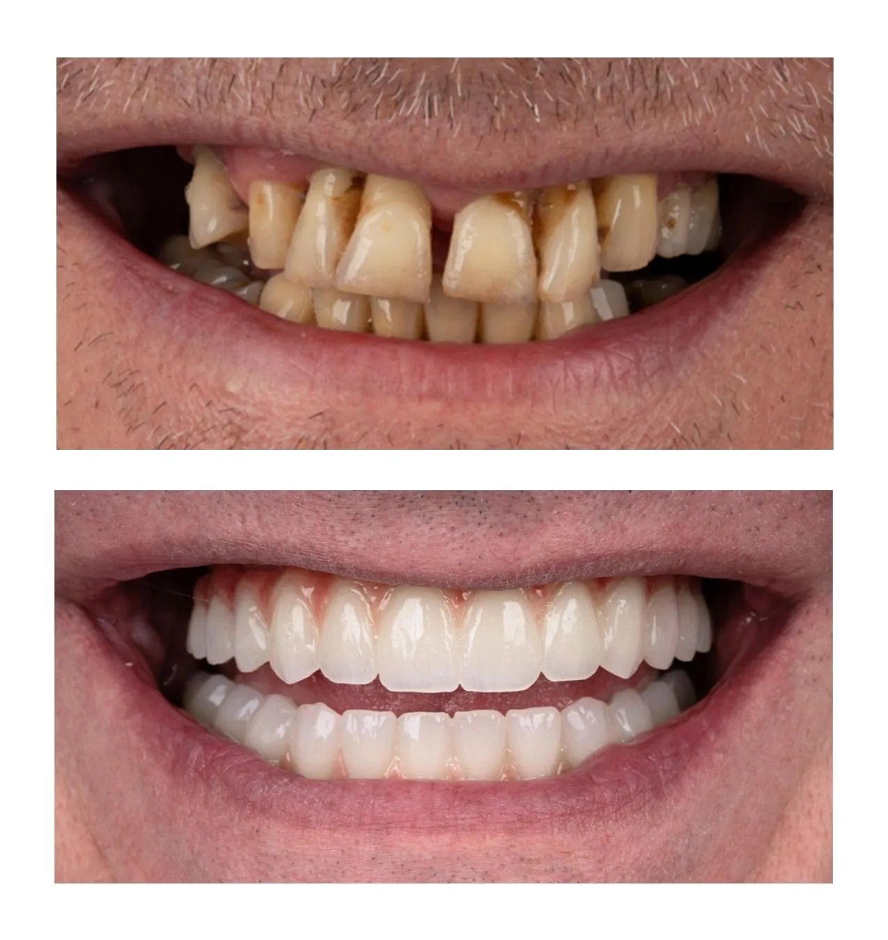 Before and after dental transformation: top shows yellow, crooked, chipped teeth; bottom shows a full set of straight, white teeth.