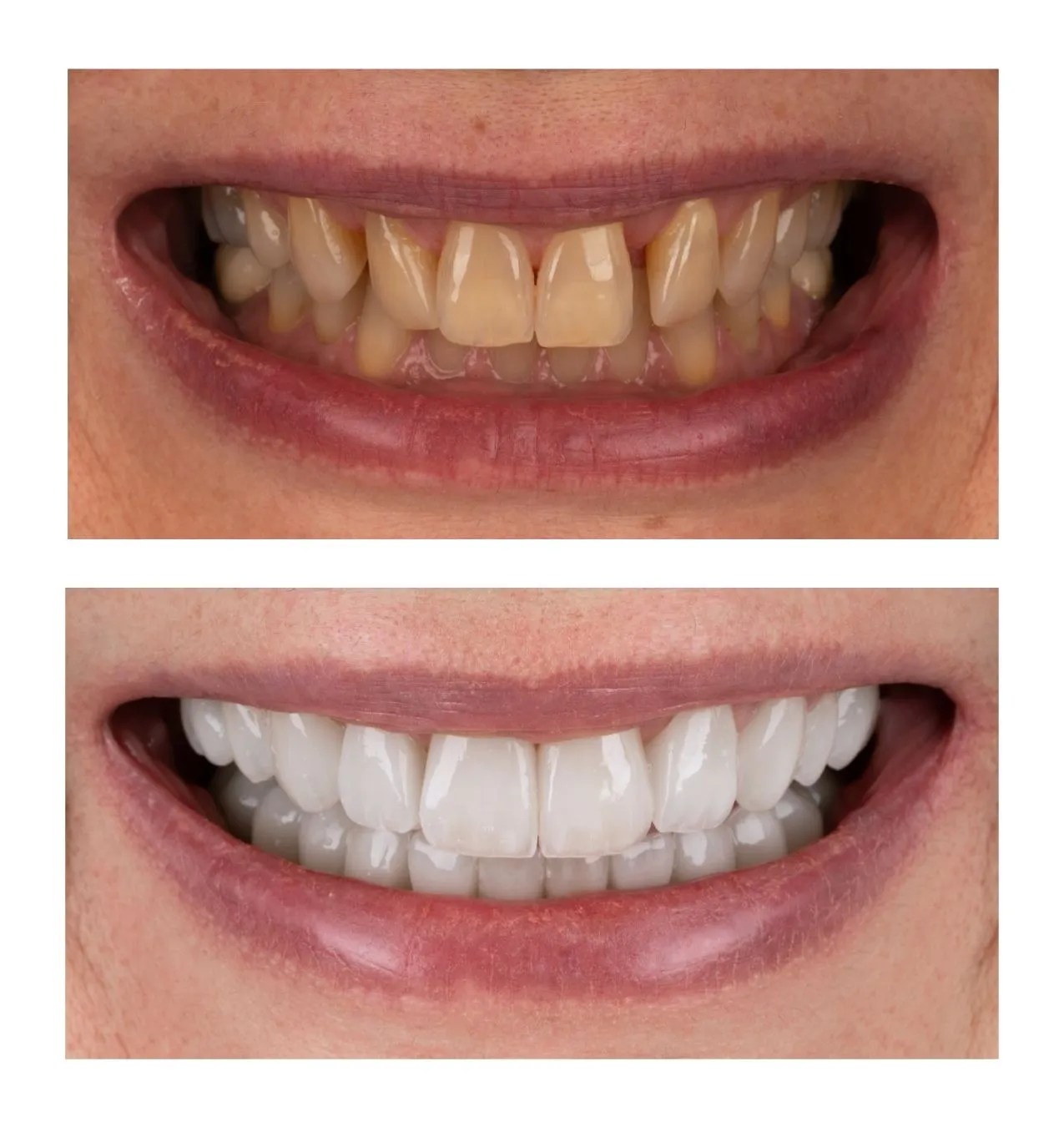 Before-and-after showing improved smile: yellow, crowded teeth above; bright, straight teeth below after whitening/orthodontic treatment