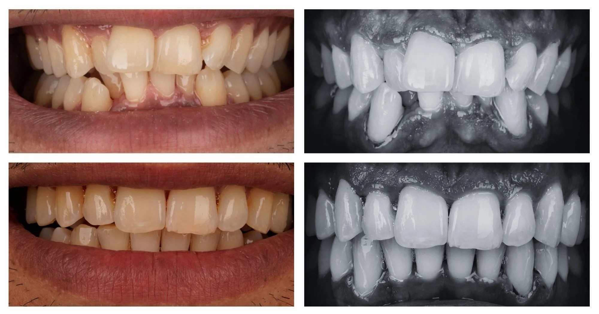 Before-and-after orthodontic comparison: left column shows crowded, misaligned teeth; right column shows a corresponding bite X-ray.