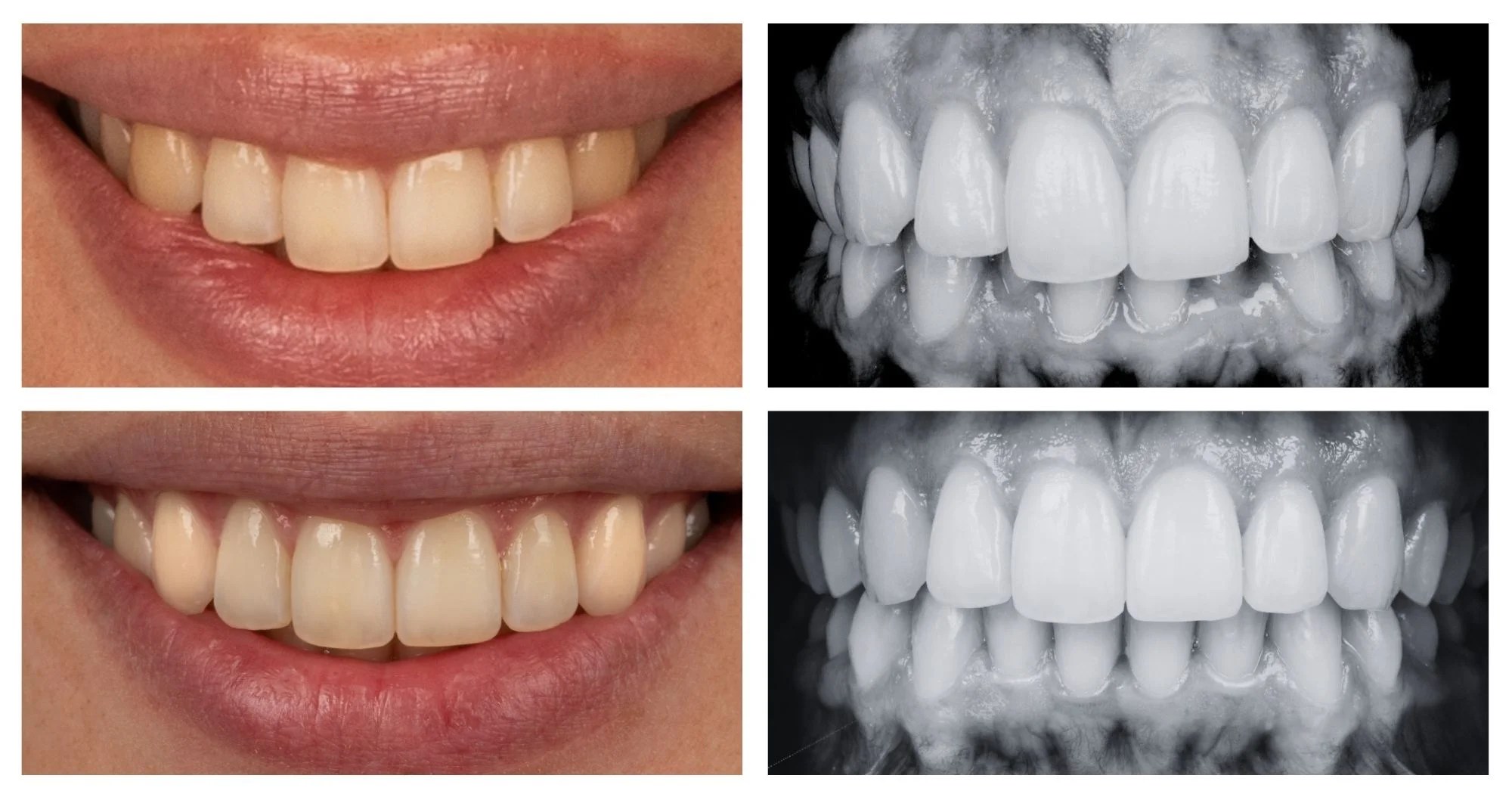 Collage comparing cosmetic dentistry: left column shows smiles before (top) and after (bottom); right column shows X-ray views of the teeth in grayscale.