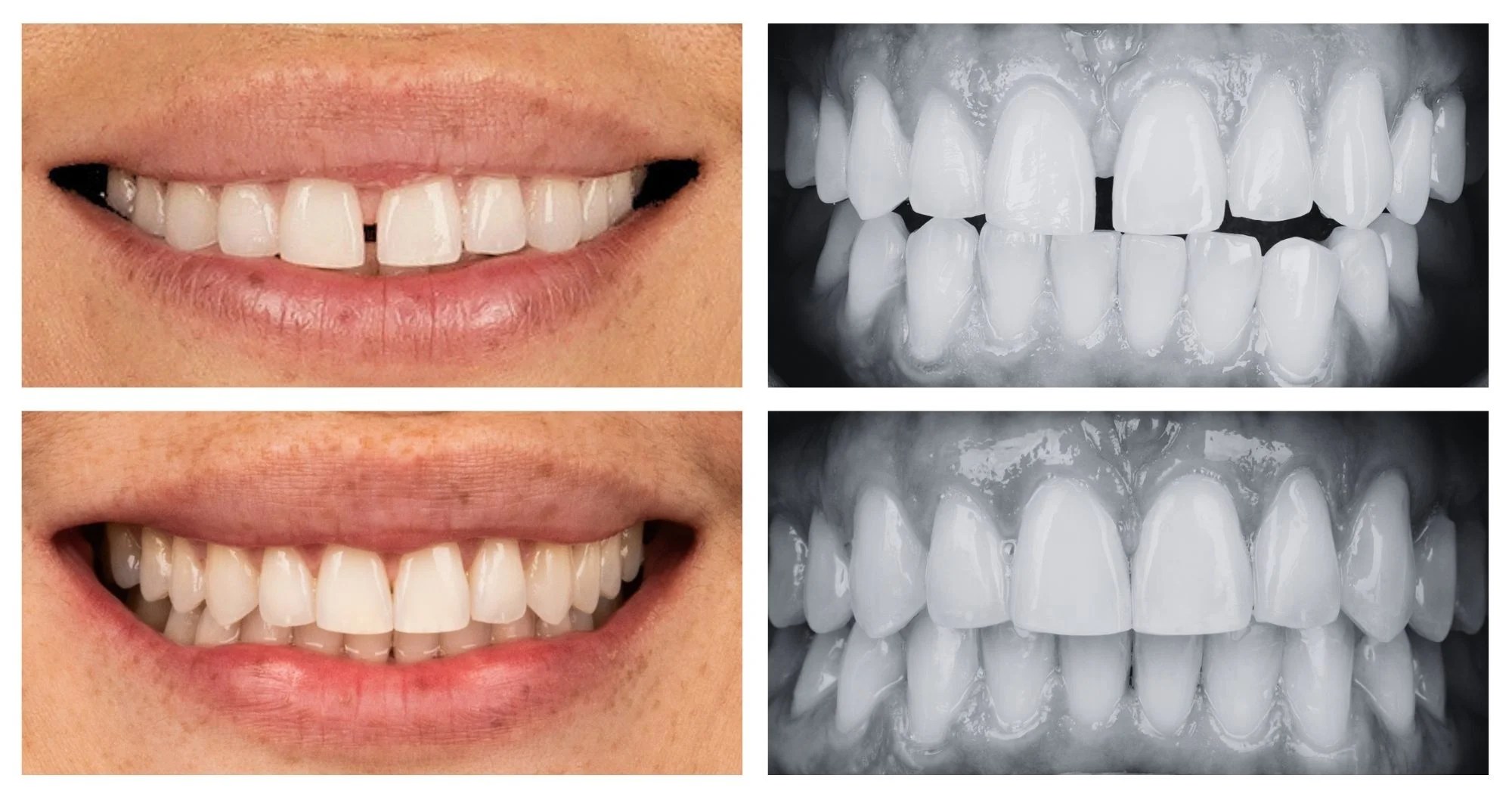 Before-and-after dental comparison: color close-ups of smiling lips and teeth on the left, grayscale close-ups of upper and lower teeth on the right indicating alignment changes.