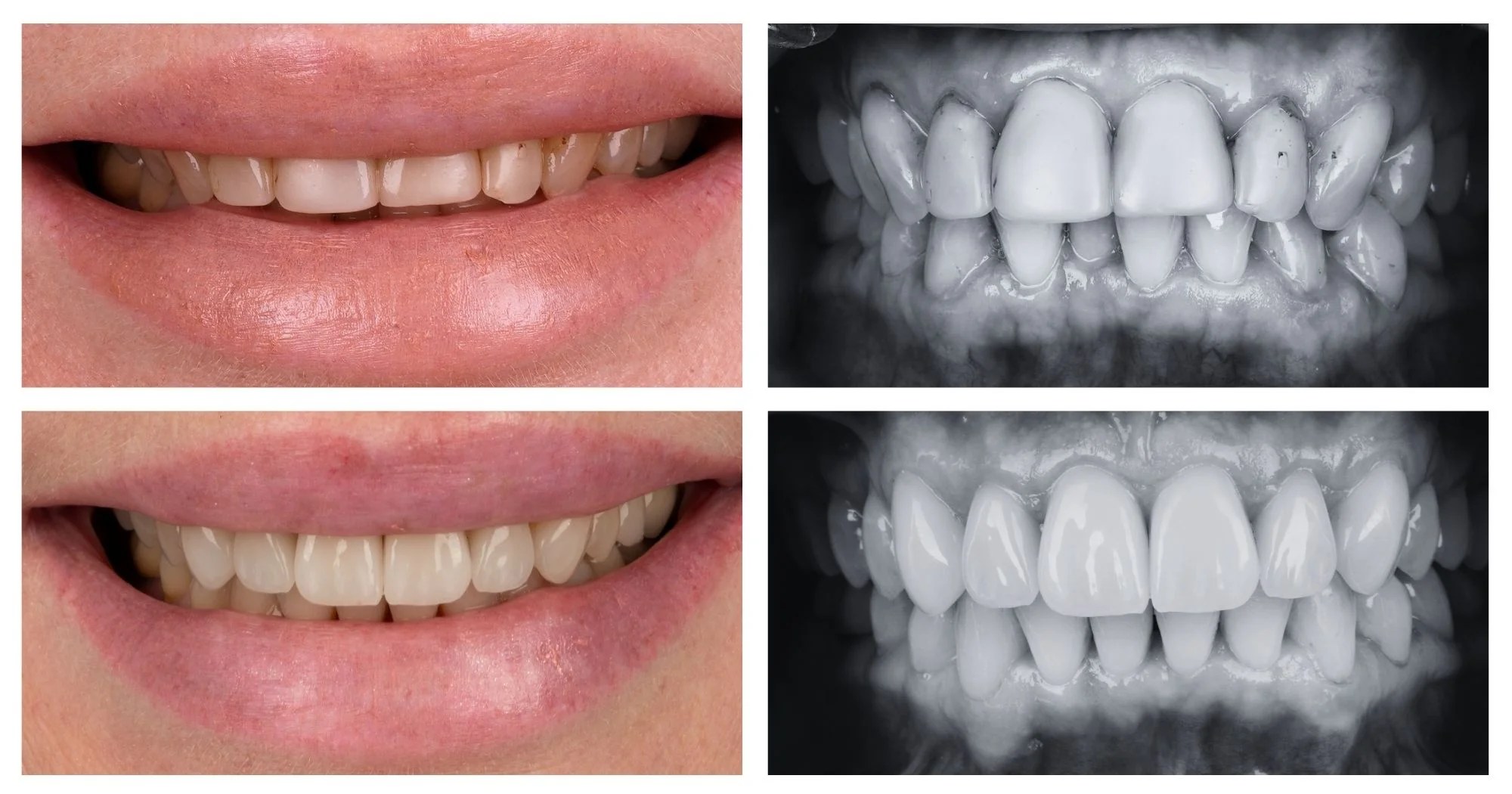 Close-up of a smiling mouth with natural teeth and pink lips (before whitening) in a side-by-side collage.