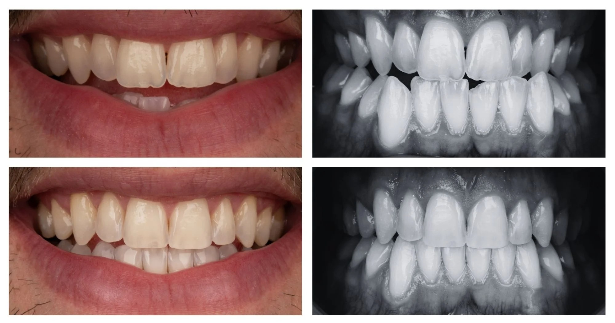 Before-and-after dental treatment collage: left column shows a smile with gaps in the upper teeth; right column shows a grayscale dental X-ray of crowded, misaligned teeth.