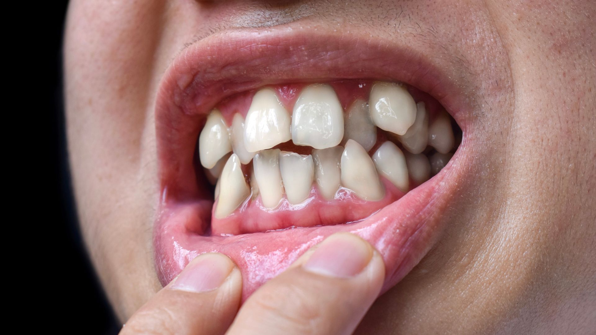 Can Invisalign fix overlapping teeth?