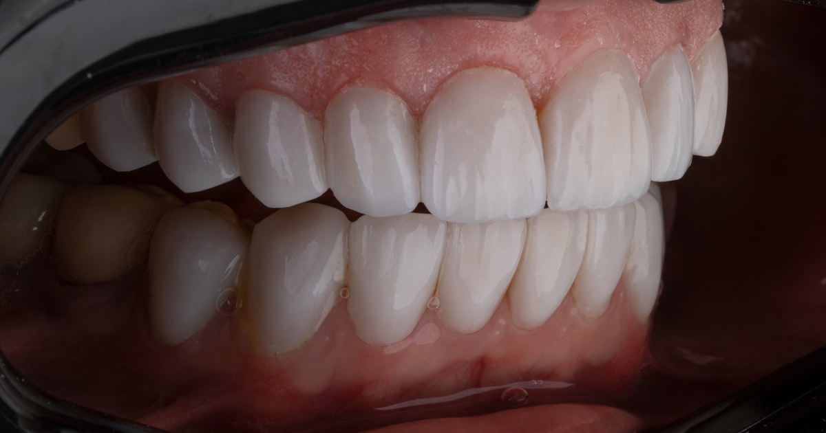 Before and After: Smile Transformations