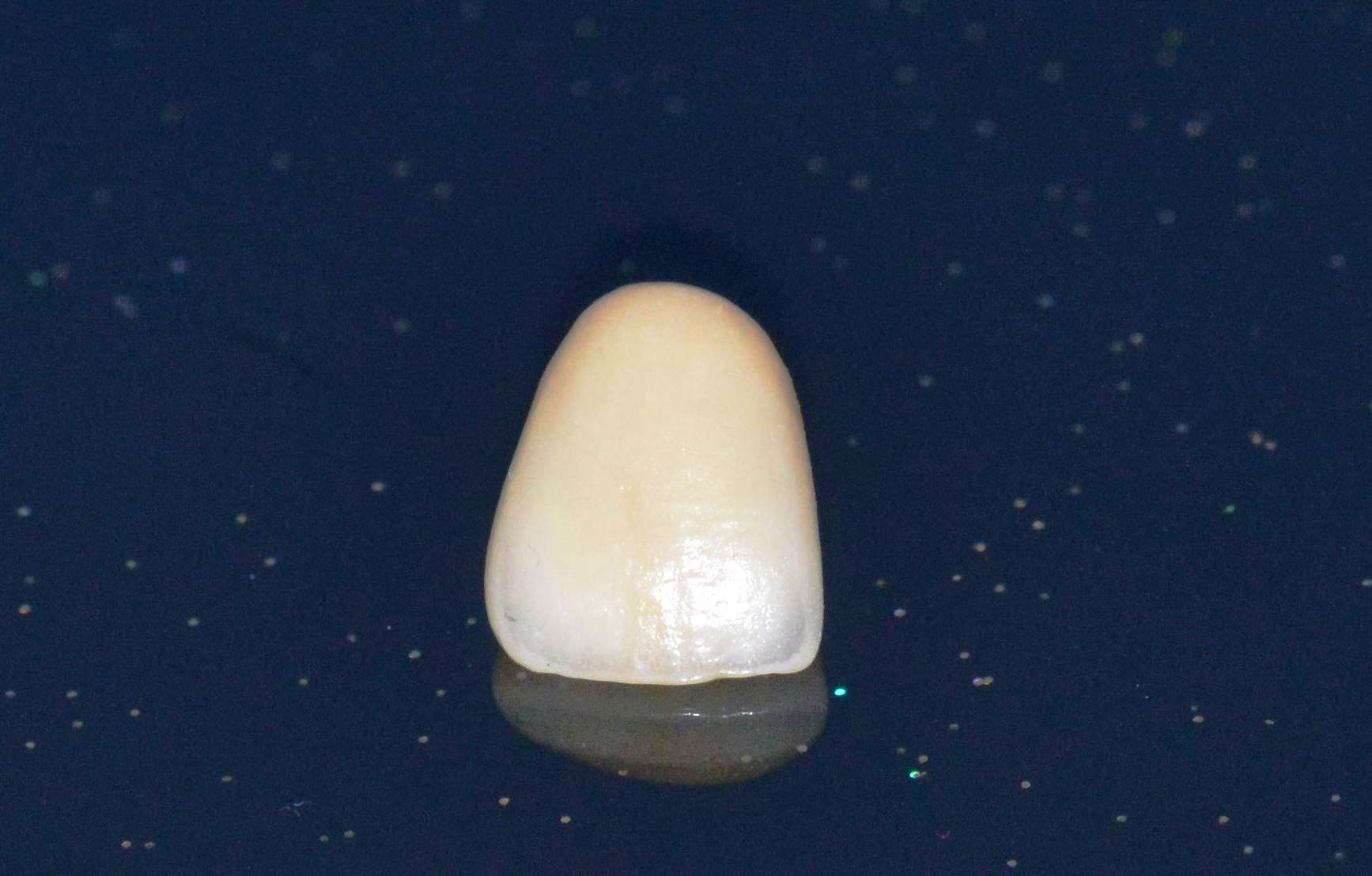 dental porcelain veneer