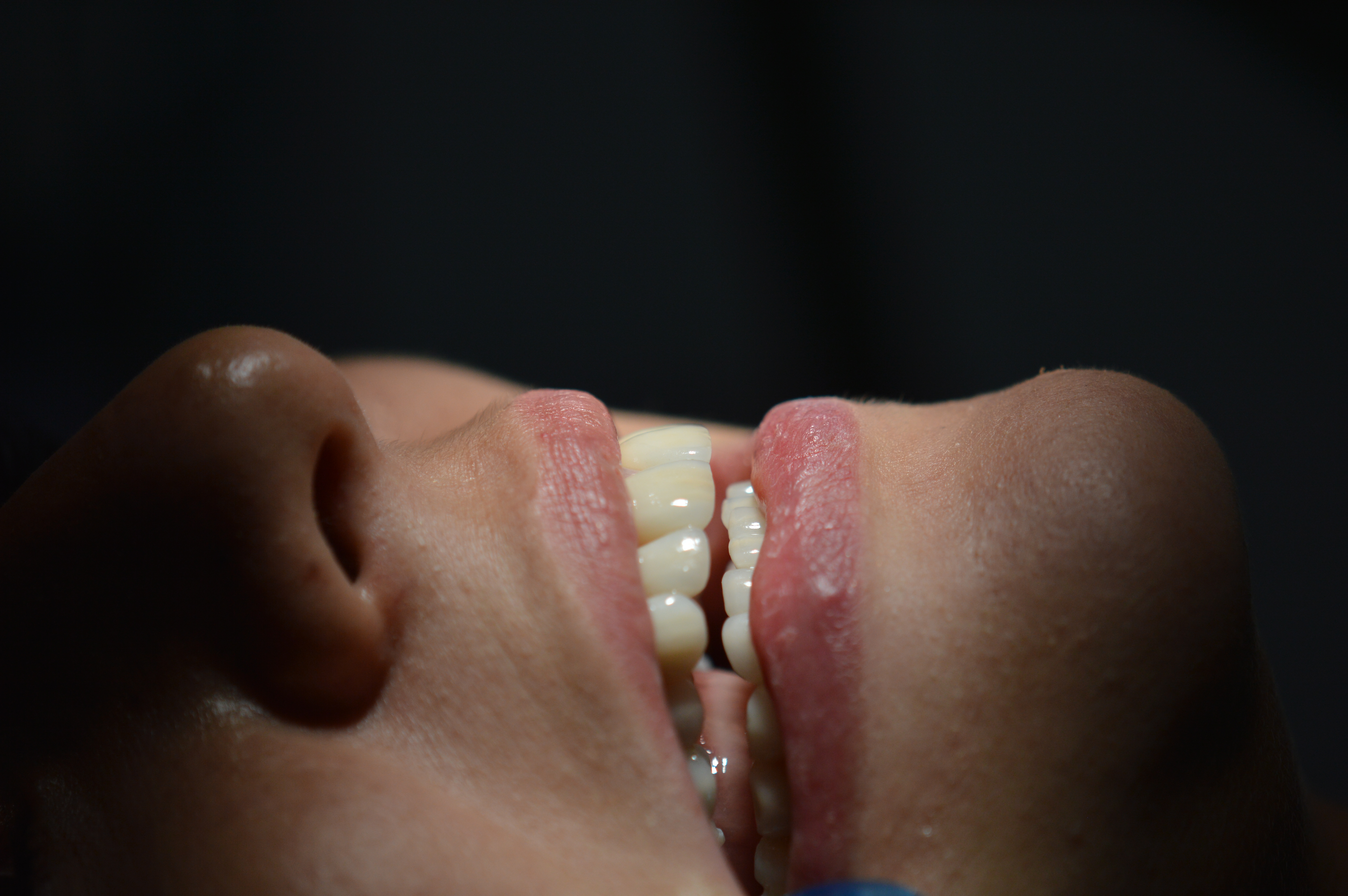 porcelain veneers