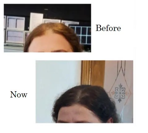 before and after effects of taking collagen for hair loss