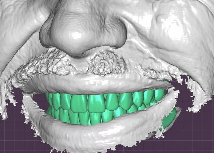 Precision face scanning for dental and prosthetic excellence