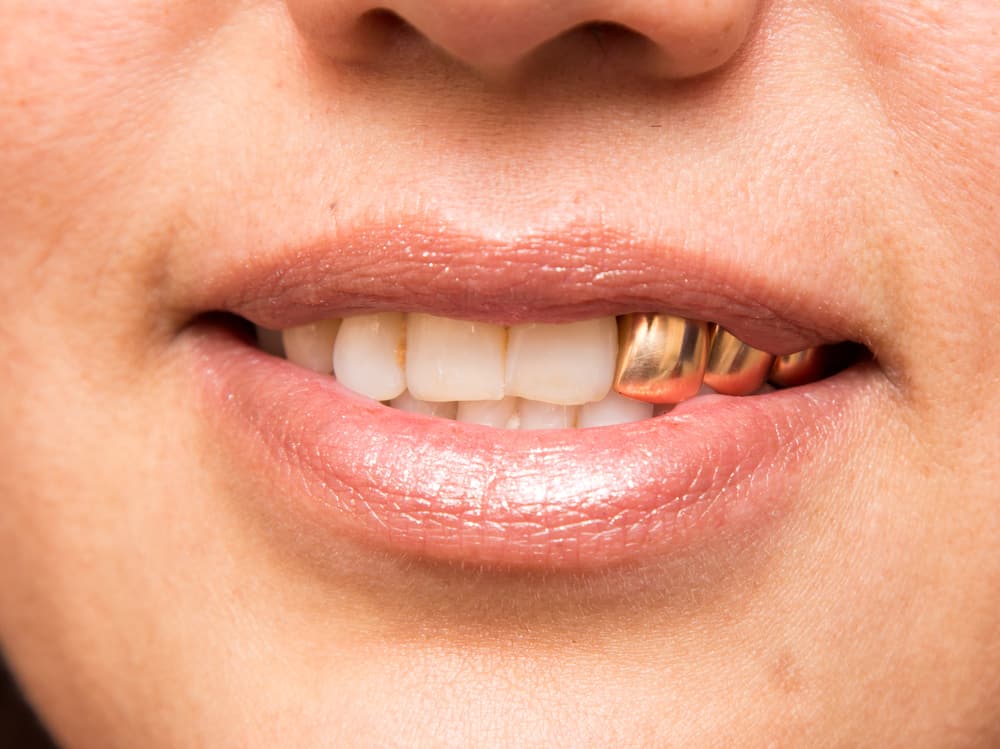 Welcome to custom teeth device. Permanent Gold Teeth History Cost Pros Cons
