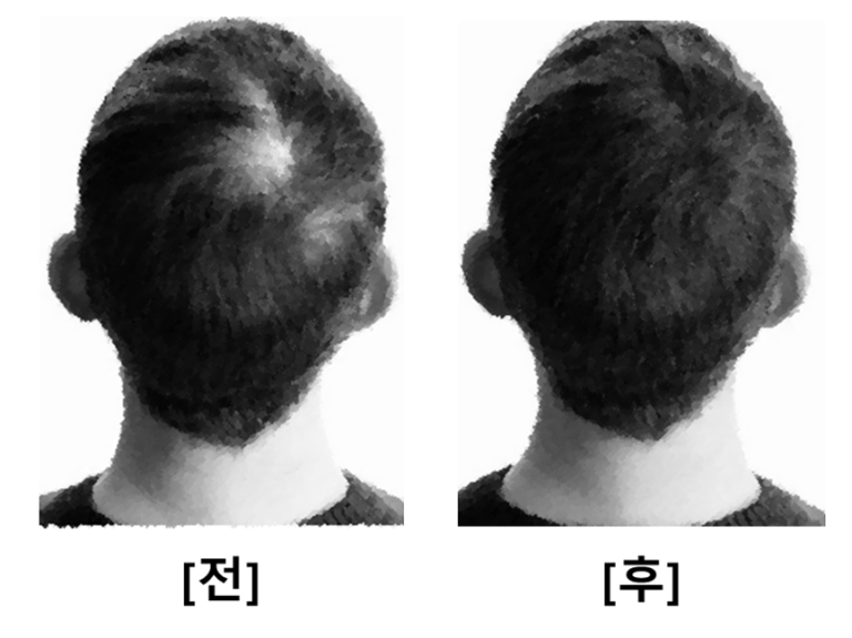 두피문신가격, 지속기간 3년? 끝장정리 (ft : 장/단점 및 FAQ) 두피문신전후