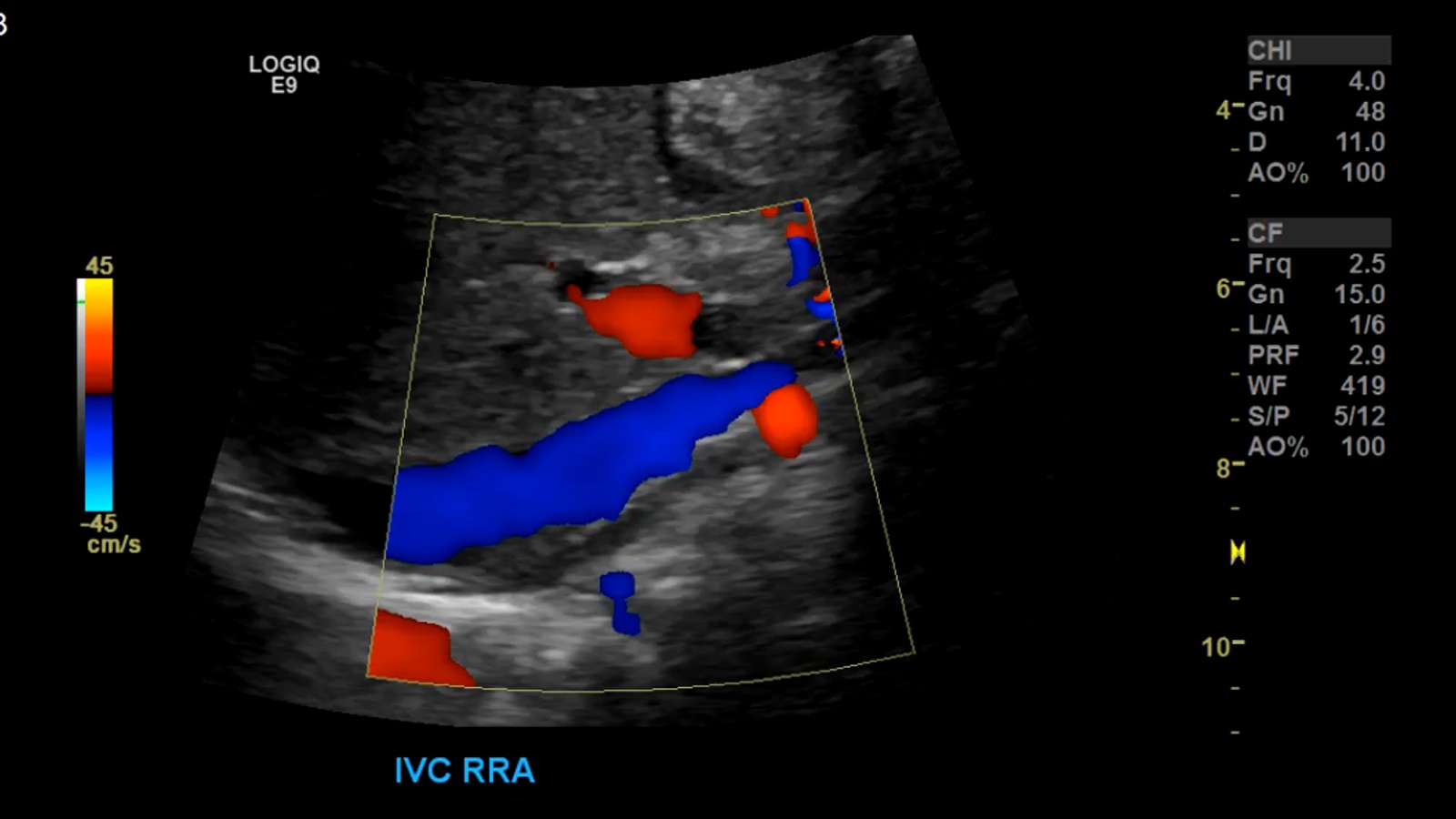 IVC prox sagittal color doppler